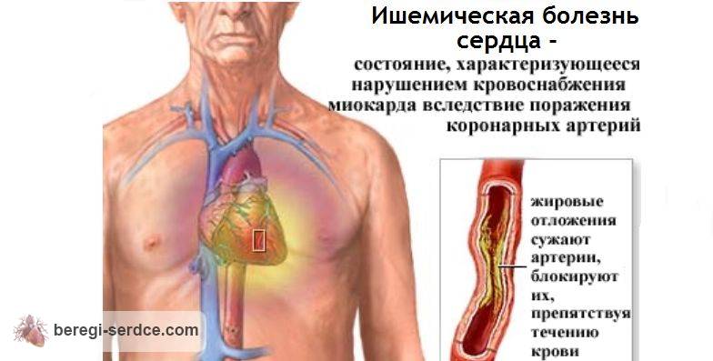ИБС