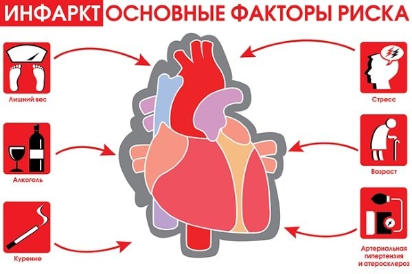 Инфаркт миокарда